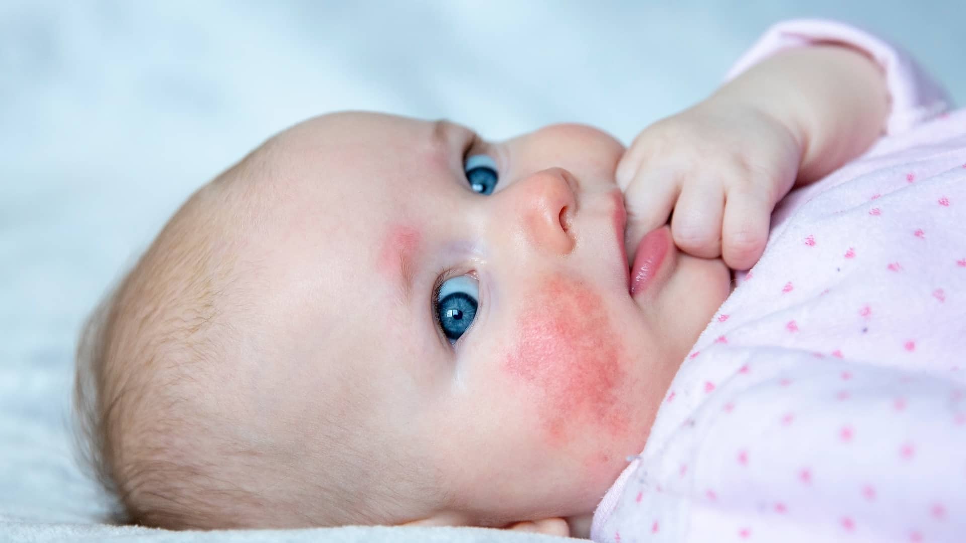 Bebé con marcas rojas en la cara por una posible alergia a ingredientes de la lactancia materna