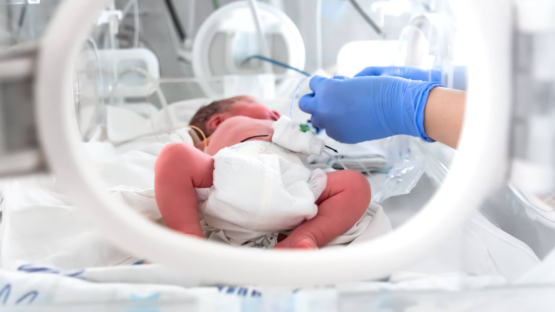 Pequeño bebé prematuro siendo atendido por el cuadro médico en un centro hospitalario