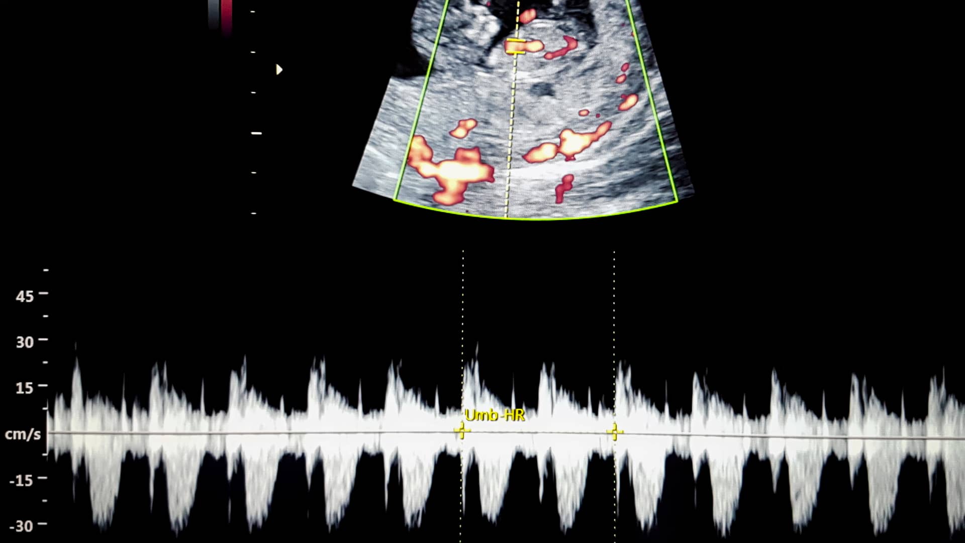 Ecografía de un bebé junto a una imagen del ritmo del latido de su corazón en la semana 12