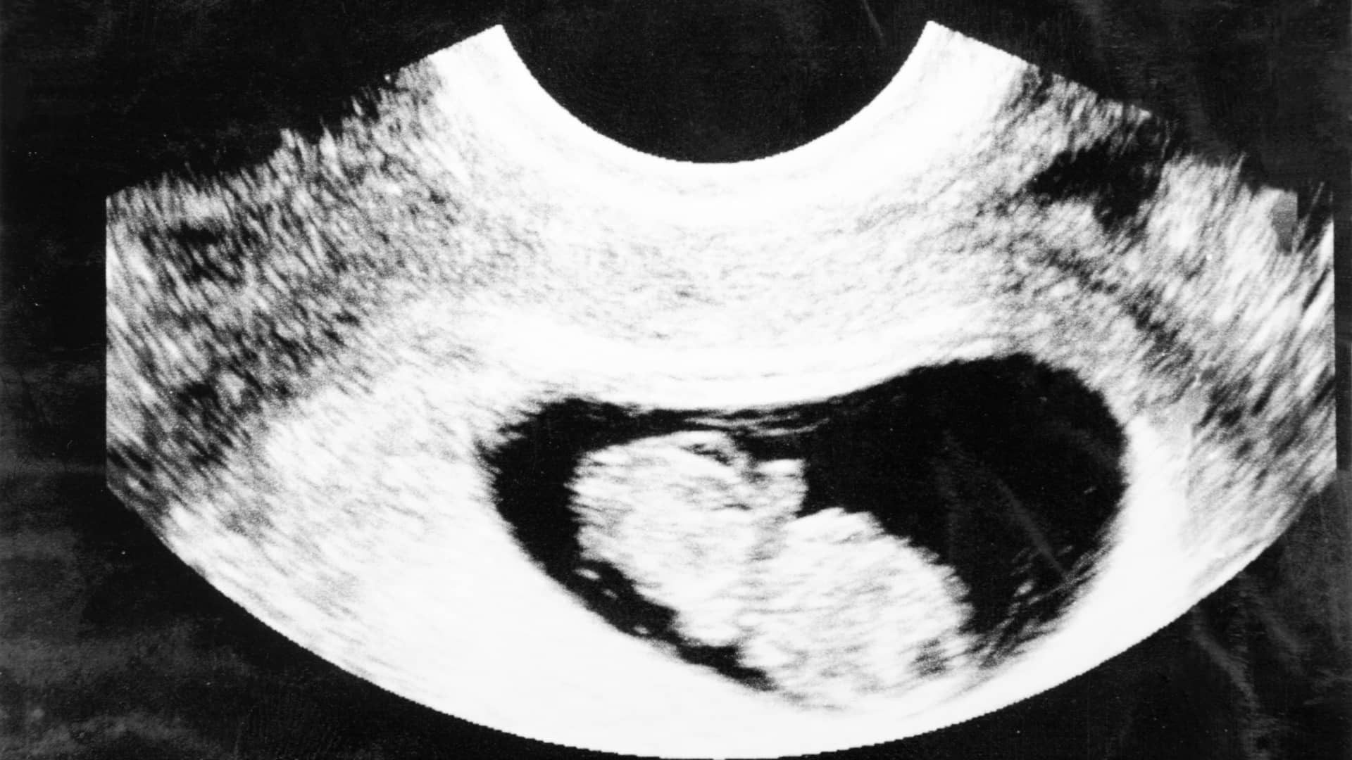 imagen de la ecografía de un feto en la semana 9 de embarazo imagen de la ecografía de un feto en la semana 9 de embarazo