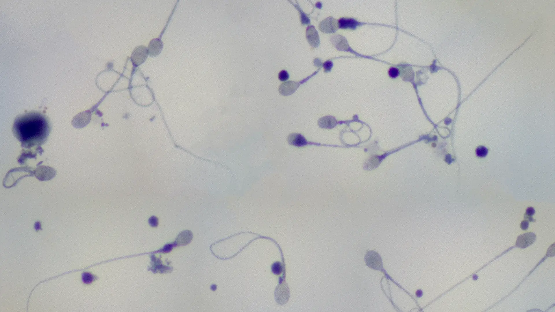 Un medico sujetando un espermatozoide para representar la calidad del semen en relacion a la fertilidad