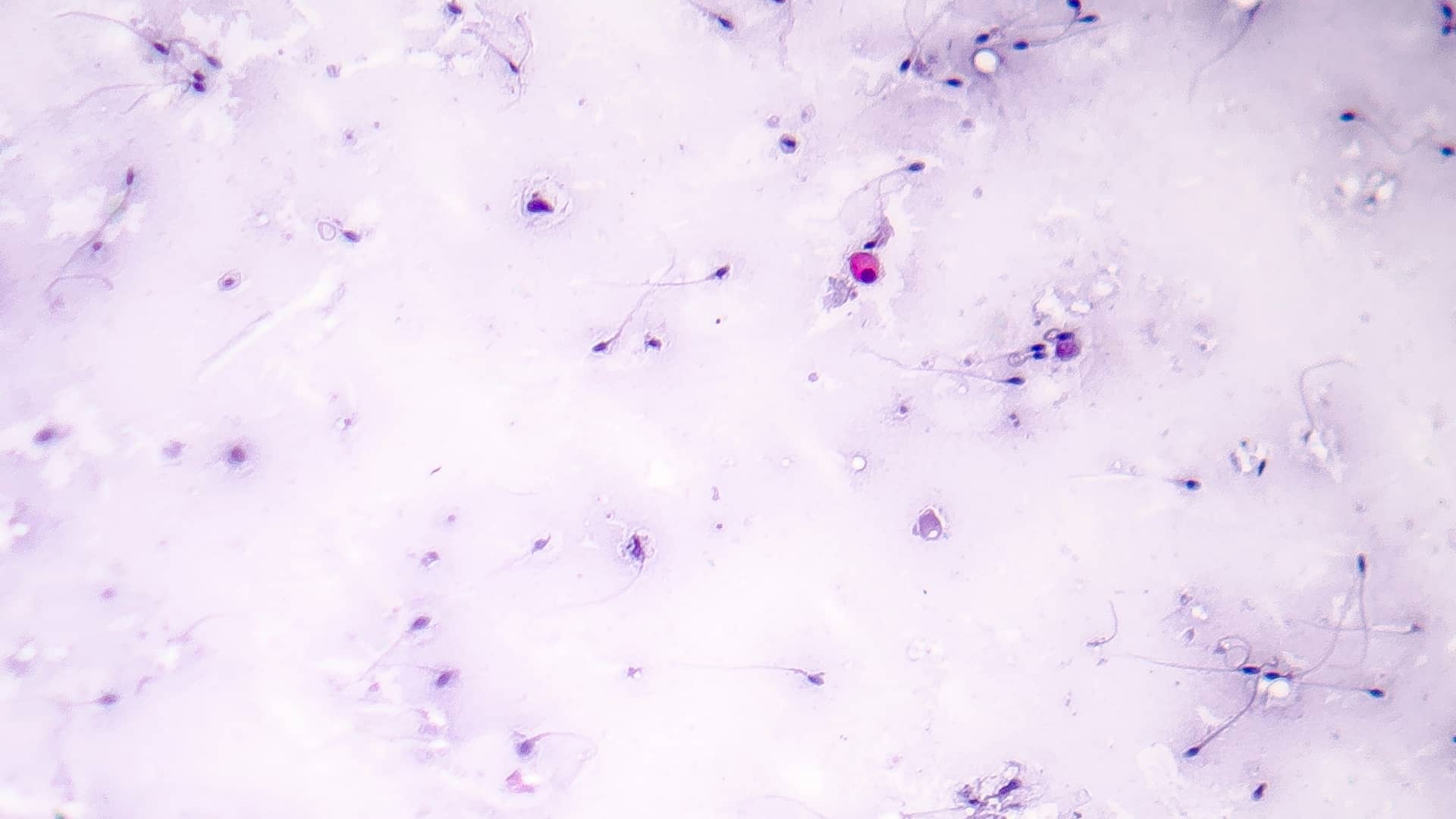 Foto en el microscopio de una muestra de semen con azoospermia que es un ejemplo de esterilidad masculiina