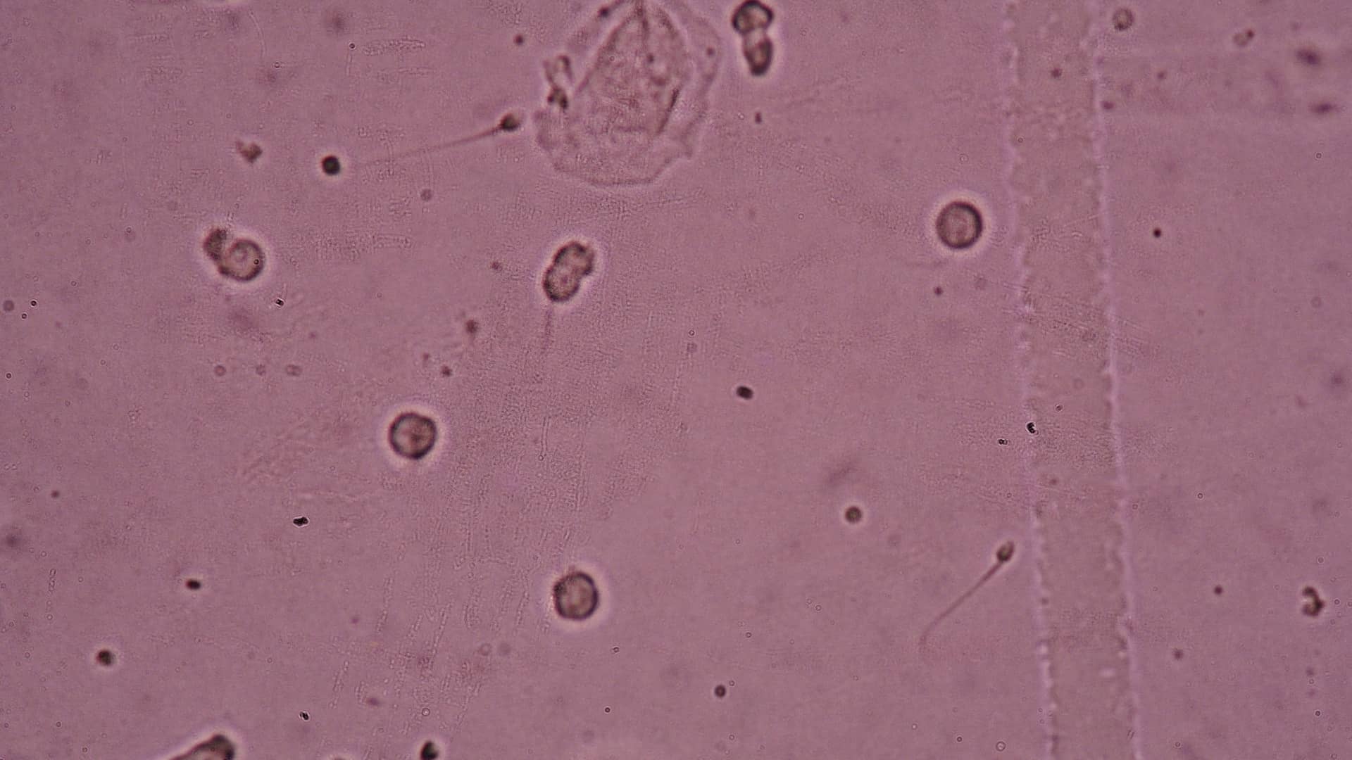Muestra de semen vista en el microscopio que representa la criptozoospermia que es un ejemplo de esterilidad masculina