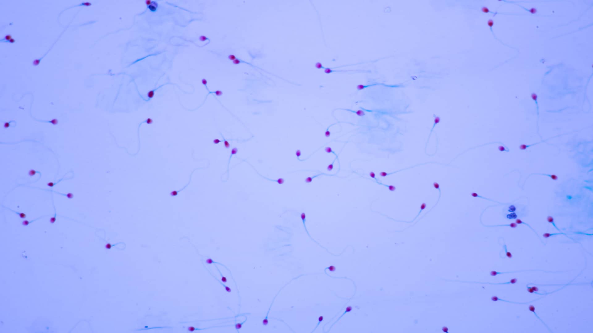 Muestra de semen vista en el microscopio que representa la hipospermia que es un ejemplo de esterilidad masculina