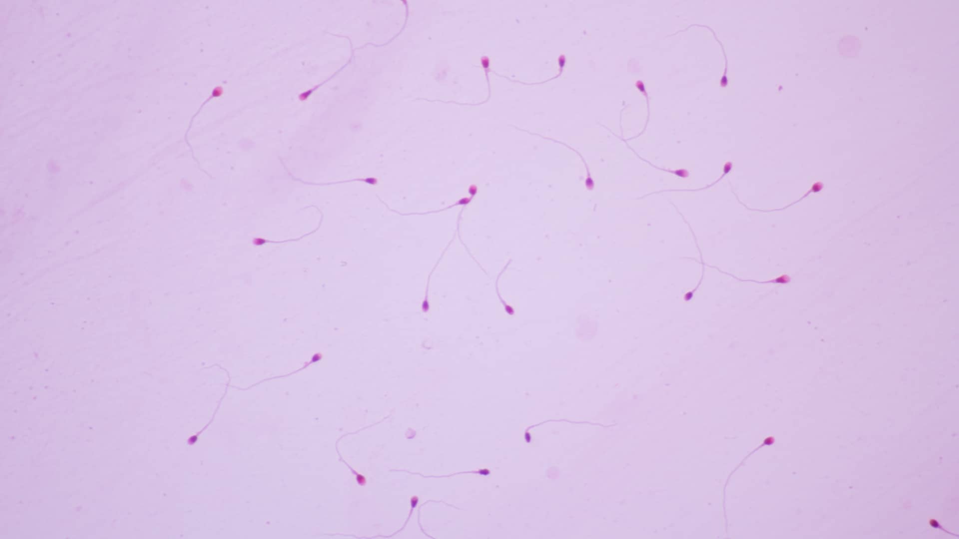 Muetsra vista en el microscopio de semen que representa la necrozoospermia que es un ejemplo de esterilidad masculina