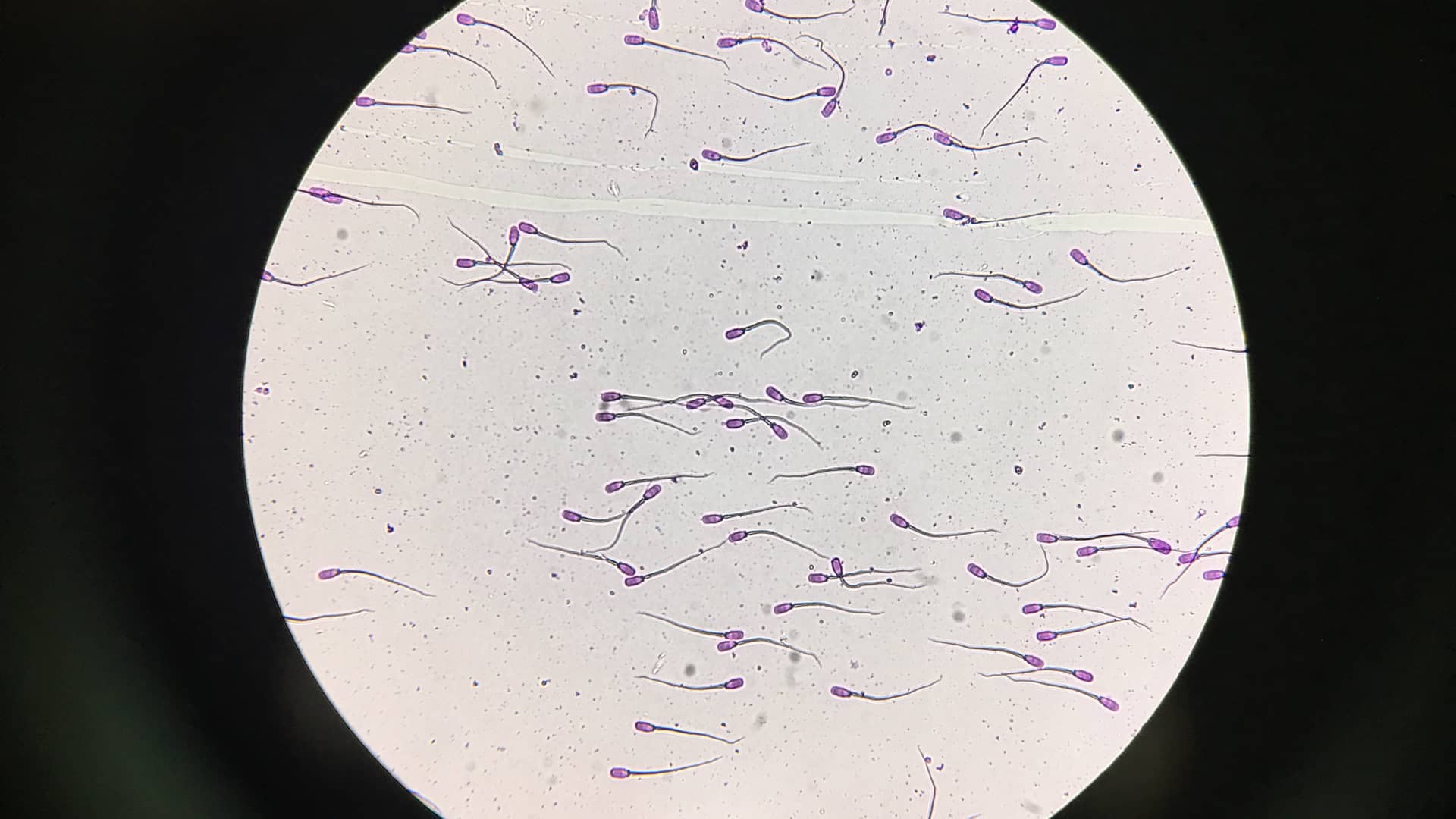 Vista en el microscopio de una muestra de semen para representar la oligoastenozoospermia que es un ejemplo de esterilidad masculina