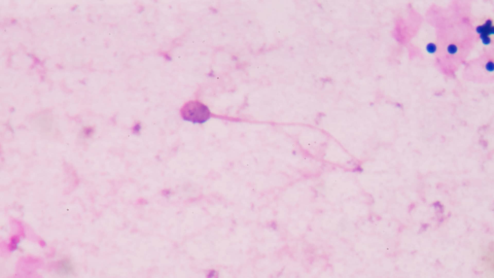 Un espermatozoide solo en una muestra para representar la oligozoospermia que es un ejemplo de esterilidad masculina