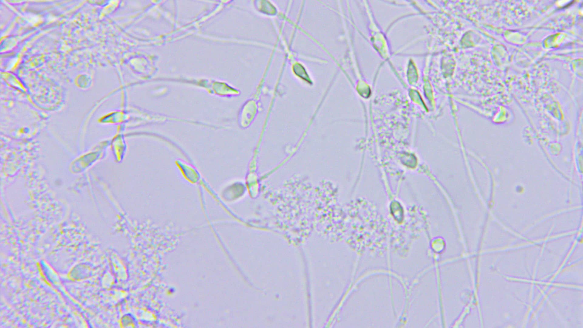 Vista en el microscopio de una muestra de semen para representar la teratozoospermia que es un ejemplo de esterildiad masculina