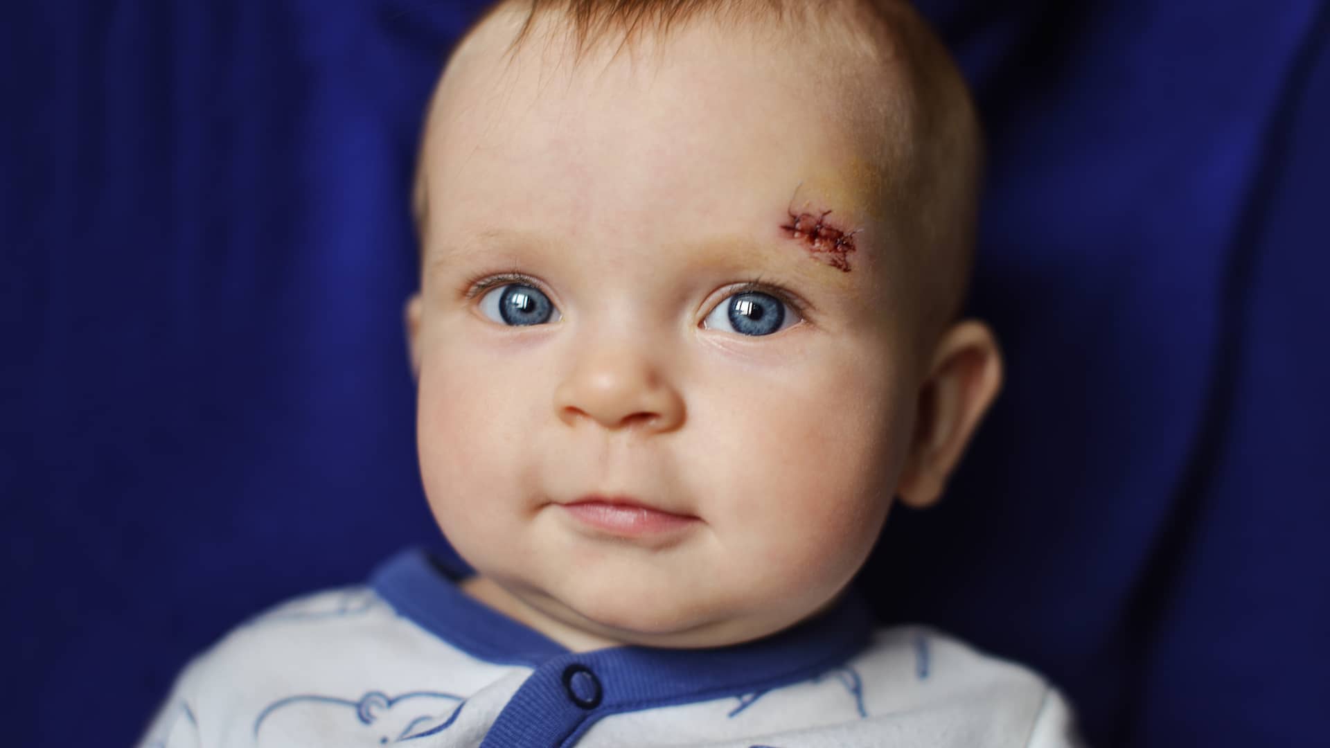 Golpe en la cabeza del bebé: ¿cuándo ir al pediatra?