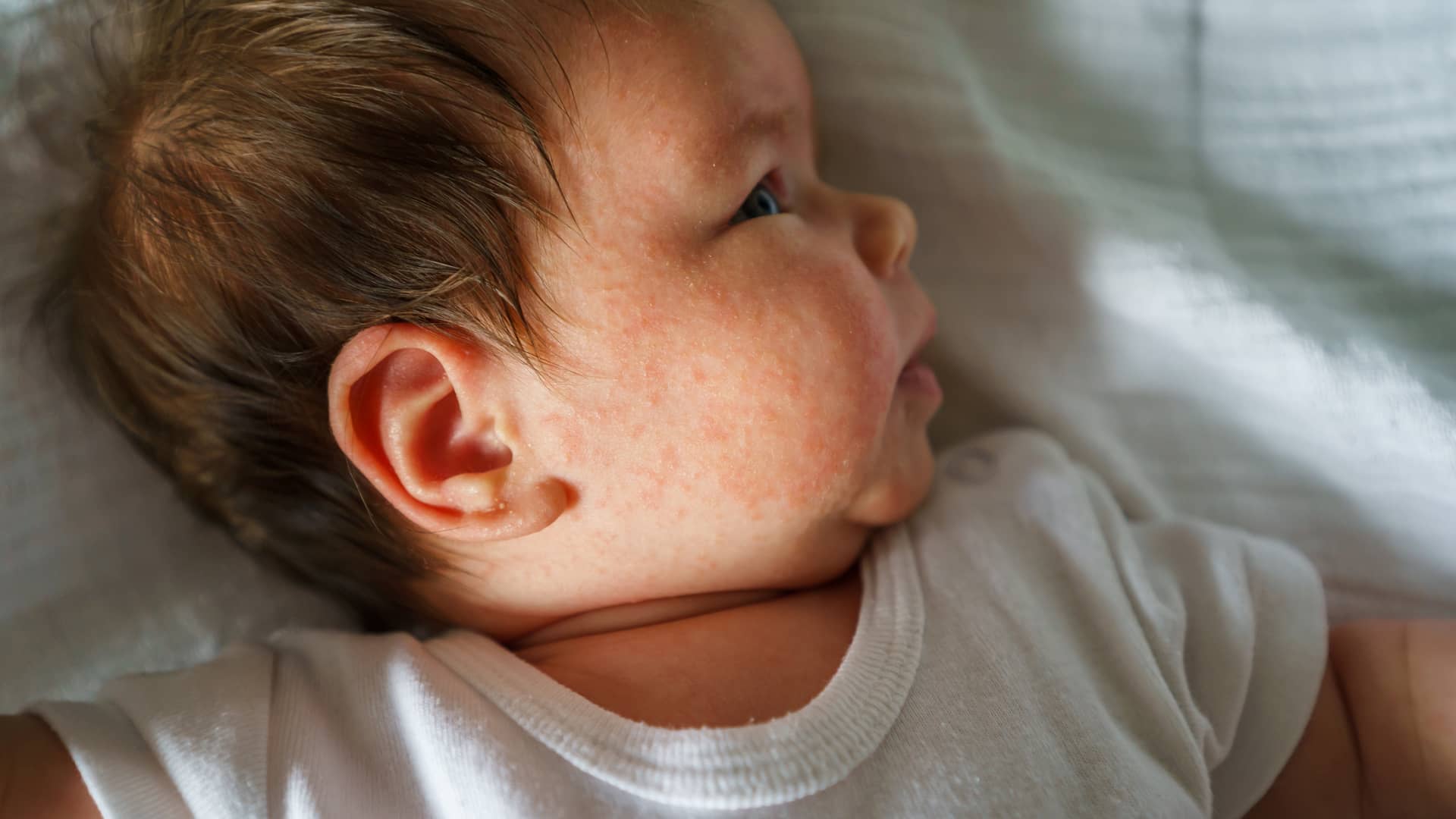 rostro de un bebe con granitos por el cuerpo por culpa de un acne por el calor