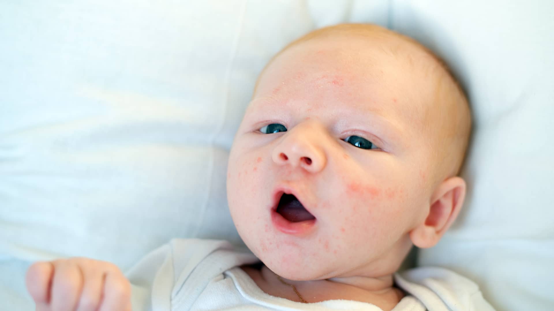 cara de un bebe llena de granitos porque tiene acne