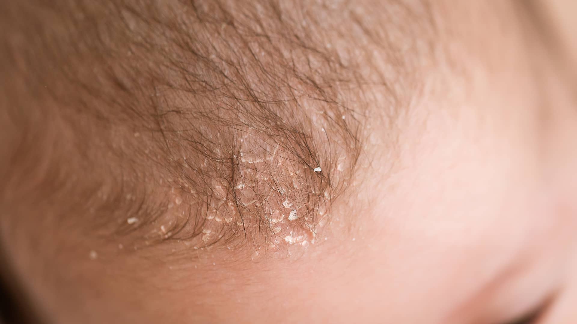 vista en detalle dela cabecita de un bebe que tiene caspa en la zona delantera del pelo
