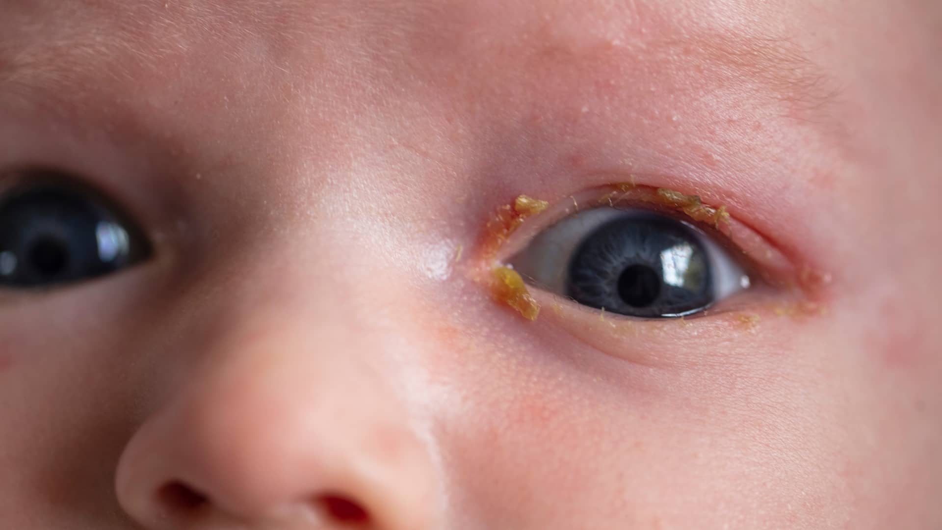 ojo de un bebe rojo y con legañas a causa de la conjuntivitis en bebes que padece ojo de un bebe rojo y con legañas a causa de la conjuntivitis en bebes que padece