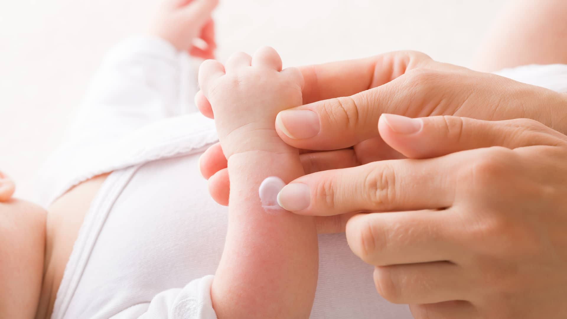 manos de una mama echando crema a su bebe que pacede dermatitis atopica