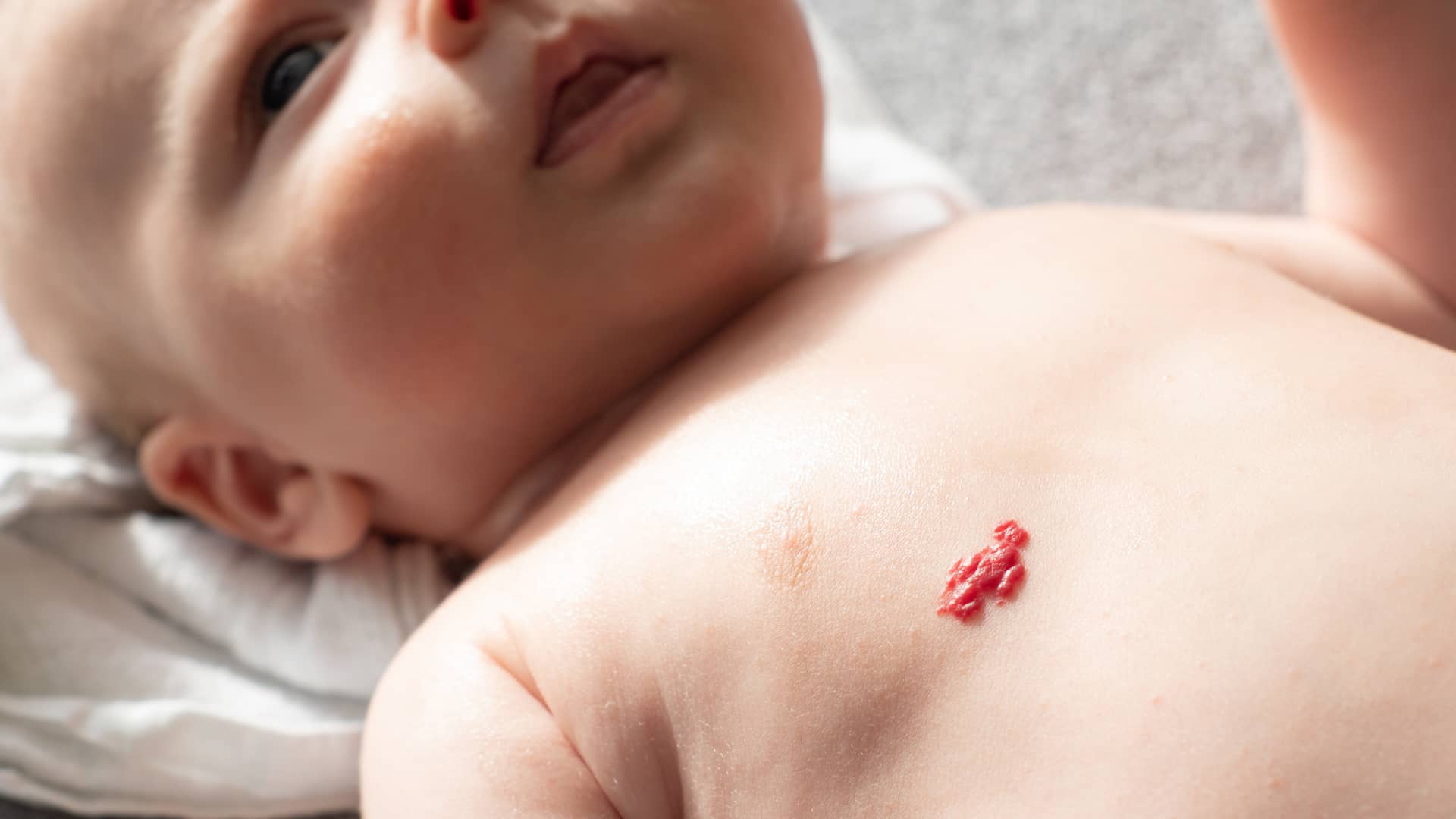 un bebe sin ropa sobre la cama con una mancha roja que es un hemangioma en el pecho