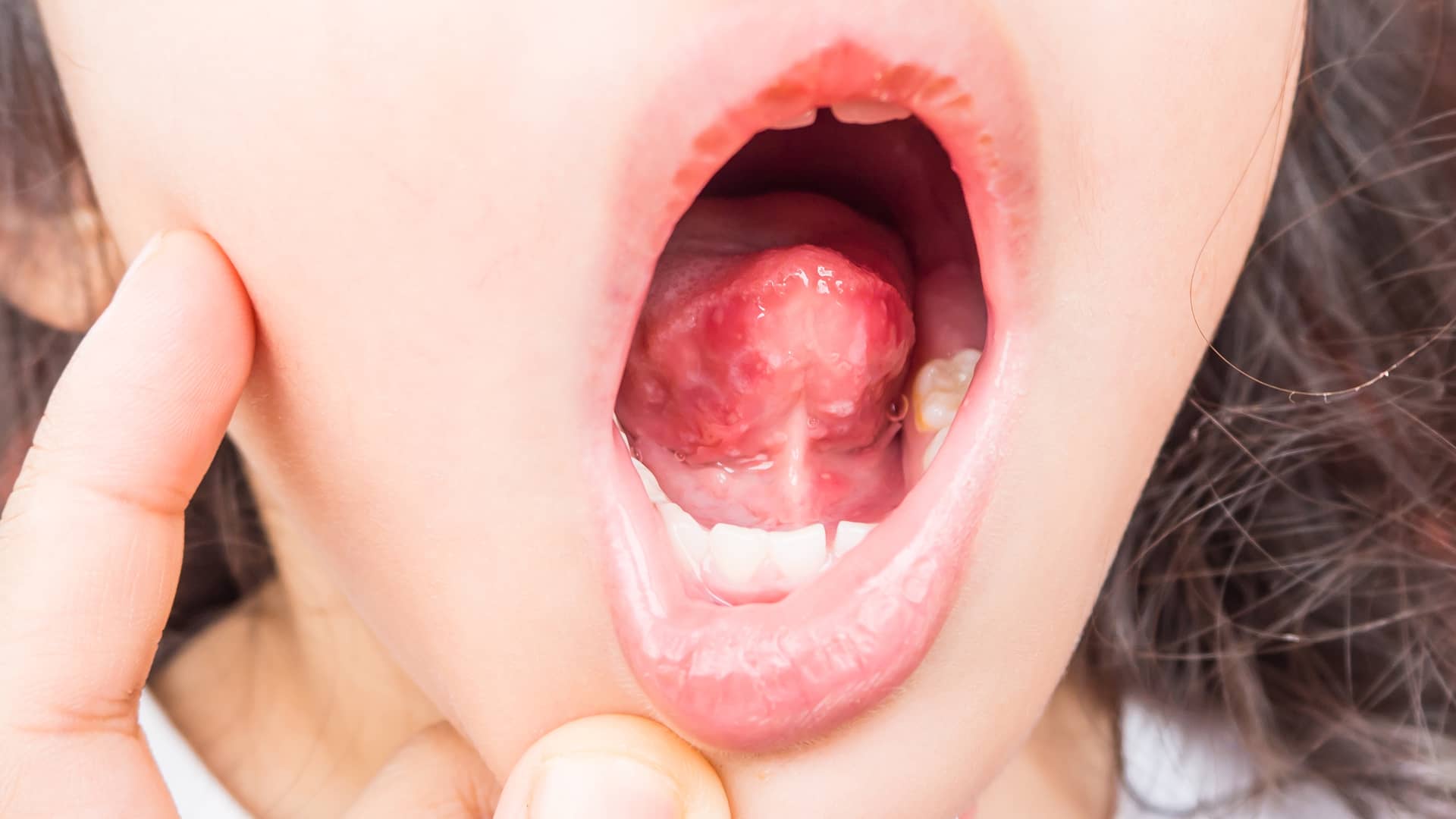 boca de una niña a la que su madre le esta mirando las ulceras que le ha provocado la herpangina boca de una niña a la que su madre le esta mirando las ulceras que le ha provocado la herpangina
