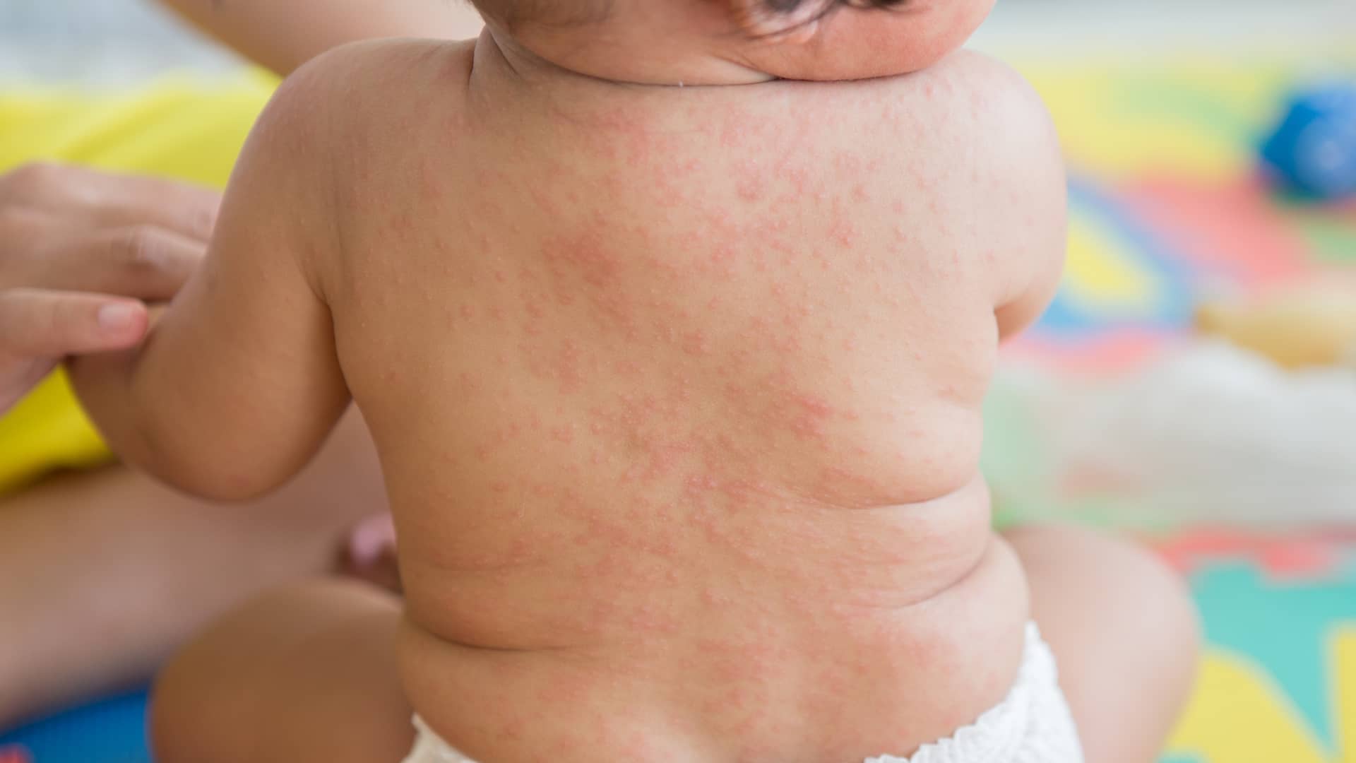 espalda de un bebe con manchas en la piel qu no le son dolorosas ni le pican
