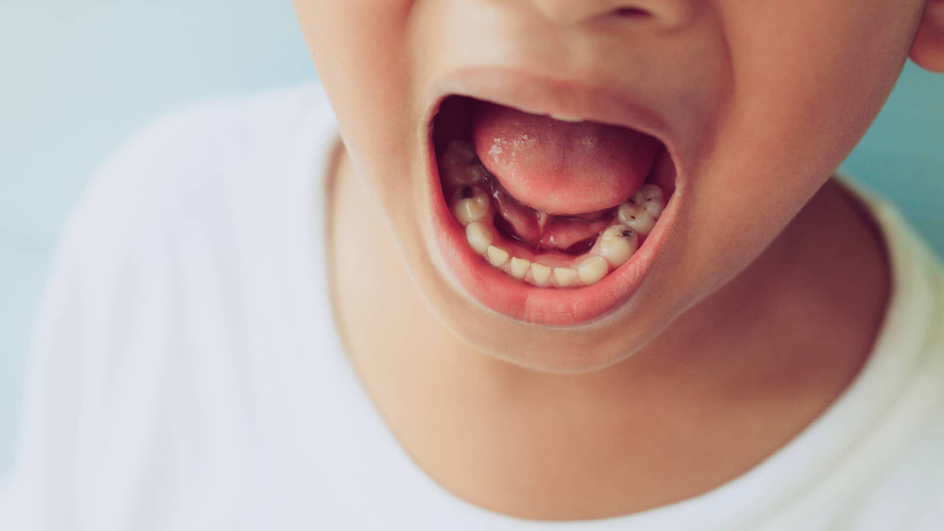 boca de un niño pequeño con pulpotomia que son caries en sus dientes de leche