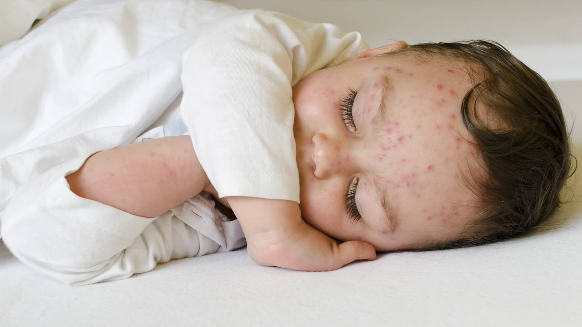 bebe dormido lleno de granitos porque tiene la varicela bebe dormido lleno de granitos porque tiene la varicela