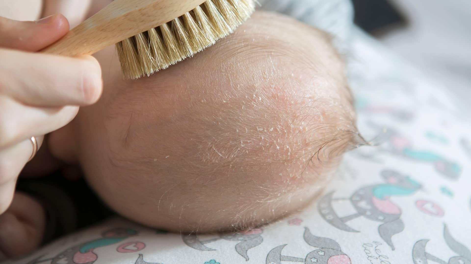 Costra láctea de la cabeza de un recién nacido